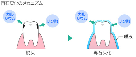 再石灰化のメカニズム 脱灰 再石灰化