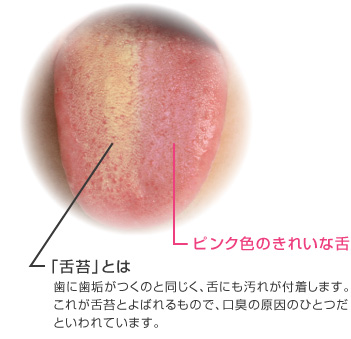 「舌苔」とは 歯に歯垢がつくのと同じく、舌にも汚れが付着します。これが舌苔とよばれるもので、口臭の原因のひとつだといわれています。